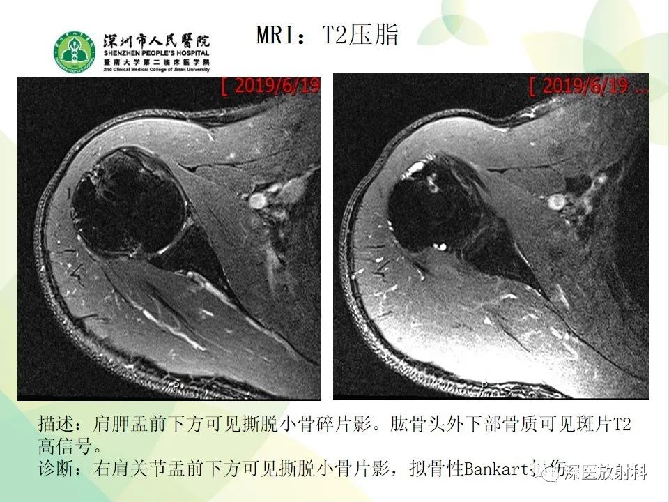 影像PPT - 【病例】Bankart损伤伴Hill-Sachs损伤1例X线MR-6