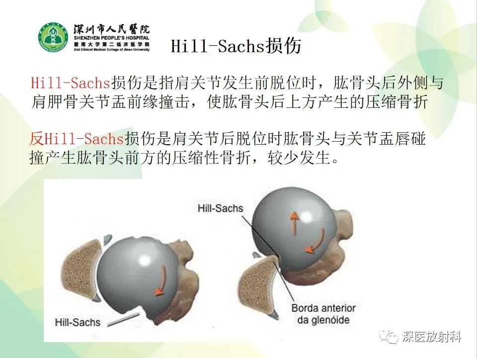 影像PPT - 【病例】Bankart损伤伴Hill-Sachs损伤1例X线MR-17