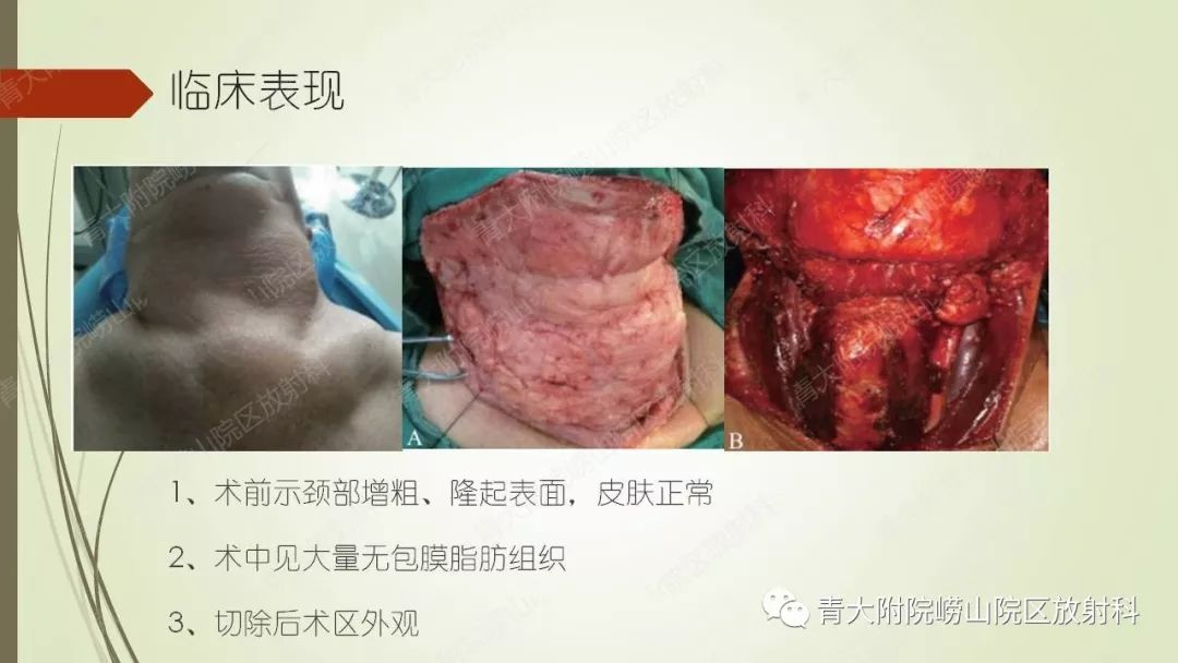 影像PPT - 【PPT】Madelung综合征-6