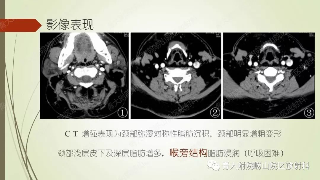影像PPT - 【PPT】Madelung综合征-7