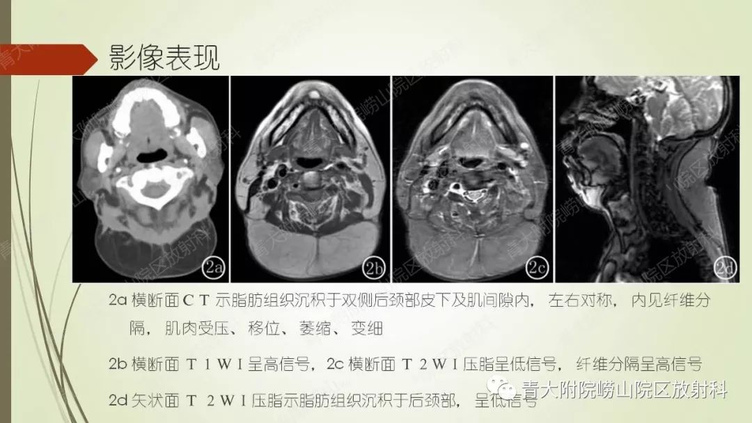 影像PPT - 【PPT】Madelung综合征-9