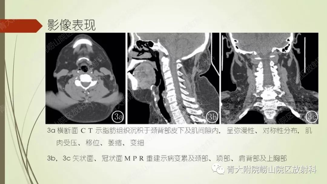 影像PPT - 【PPT】Madelung综合征-10