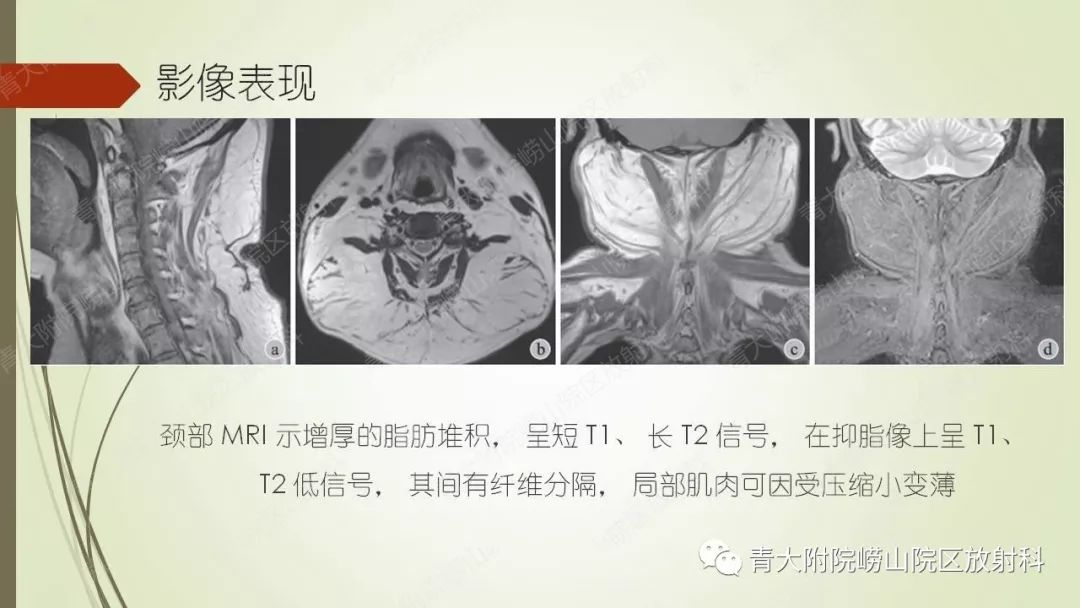 影像PPT - 【PPT】Madelung综合征-11