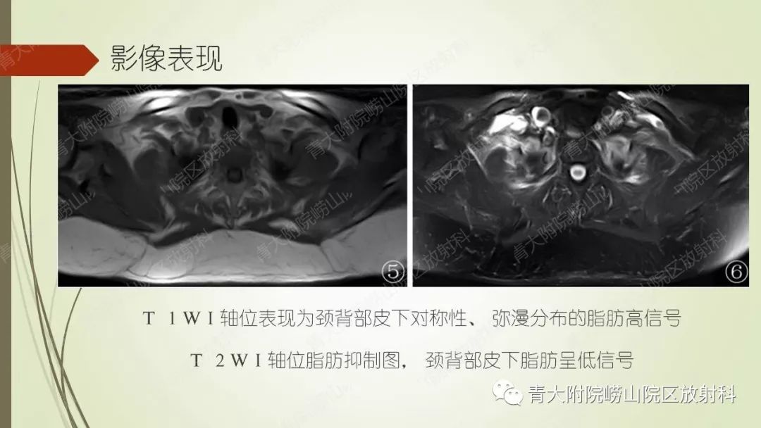 影像PPT - 【PPT】Madelung综合征-8