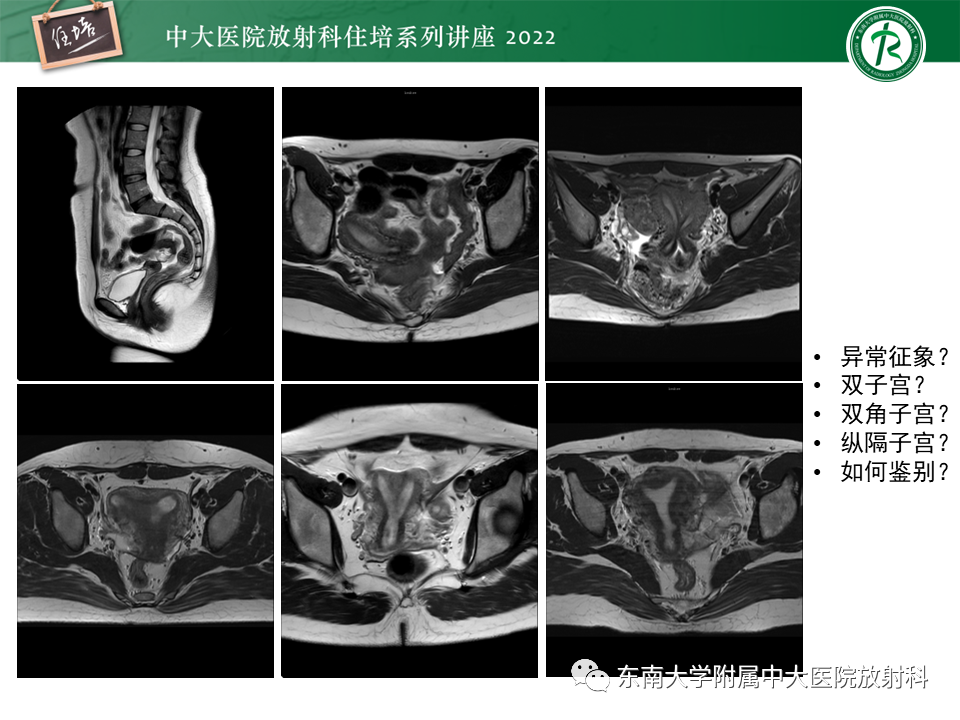 影像PPT - 【PPT】子宫畸形的分型与MR表现-2