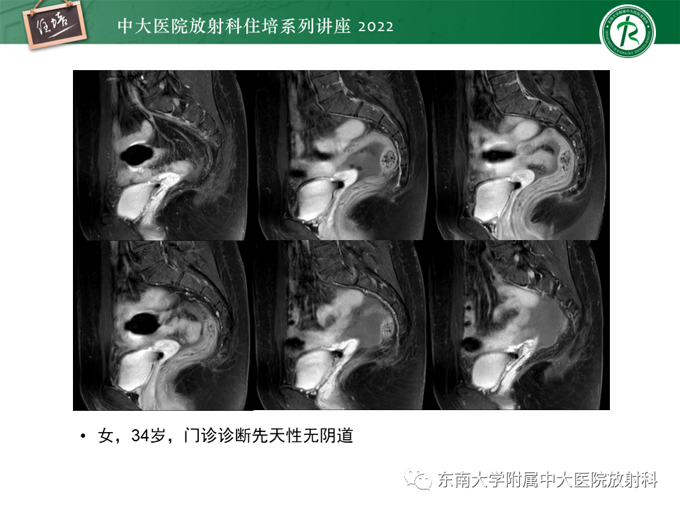 影像PPT - 【PPT】子宫畸形的分型与MR表现-13