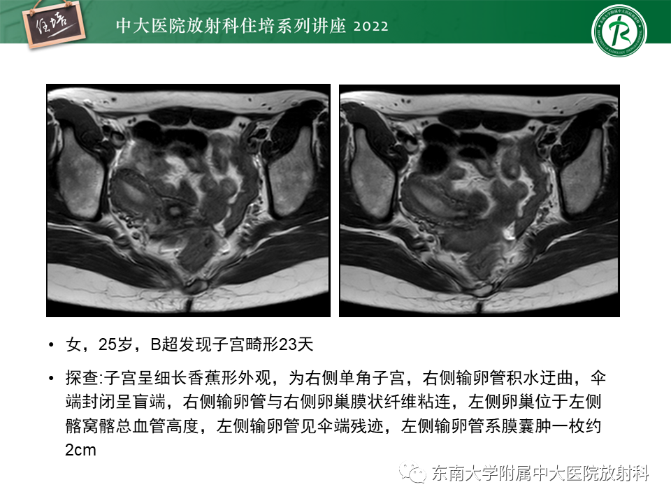 影像PPT - 【PPT】子宫畸形的分型与MR表现-15