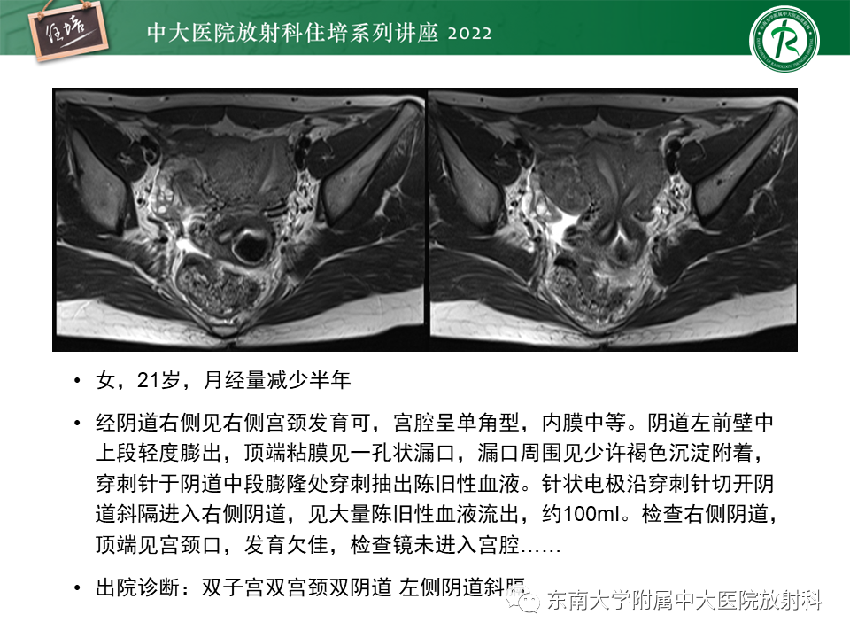 影像PPT - 【PPT】子宫畸形的分型与MR表现-17