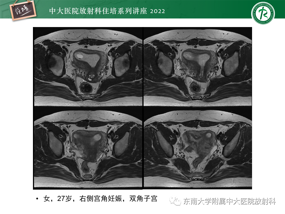 影像PPT - 【PPT】子宫畸形的分型与MR表现-19