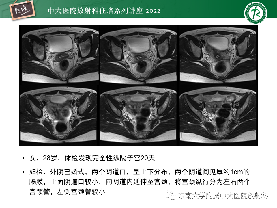 影像PPT - 【PPT】子宫畸形的分型与MR表现-21