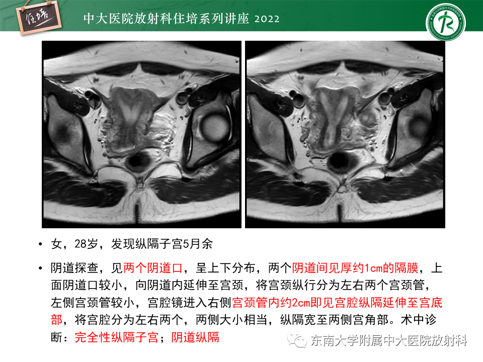 影像PPT - 【PPT】子宫畸形的分型与MR表现-22