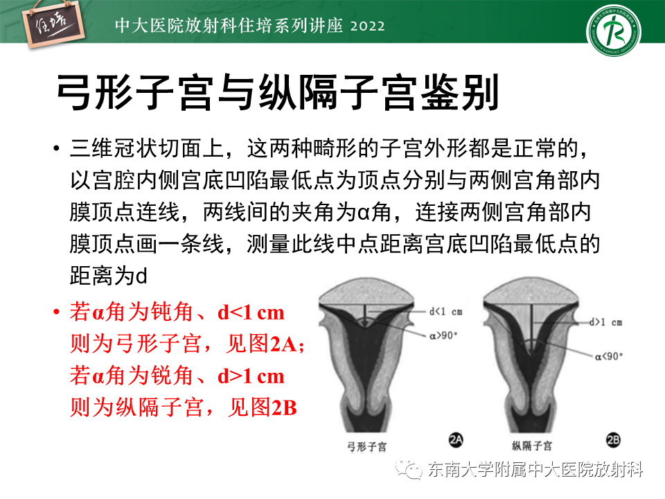 影像PPT - 【PPT】子宫畸形的分型与MR表现-26