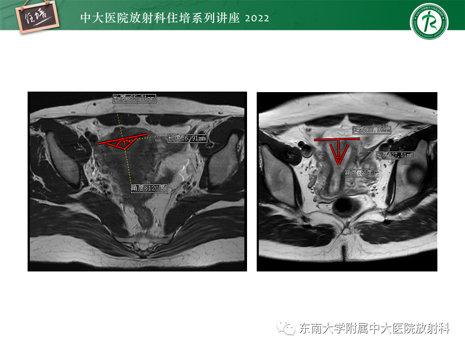 影像PPT - 【PPT】子宫畸形的分型与MR表现-27