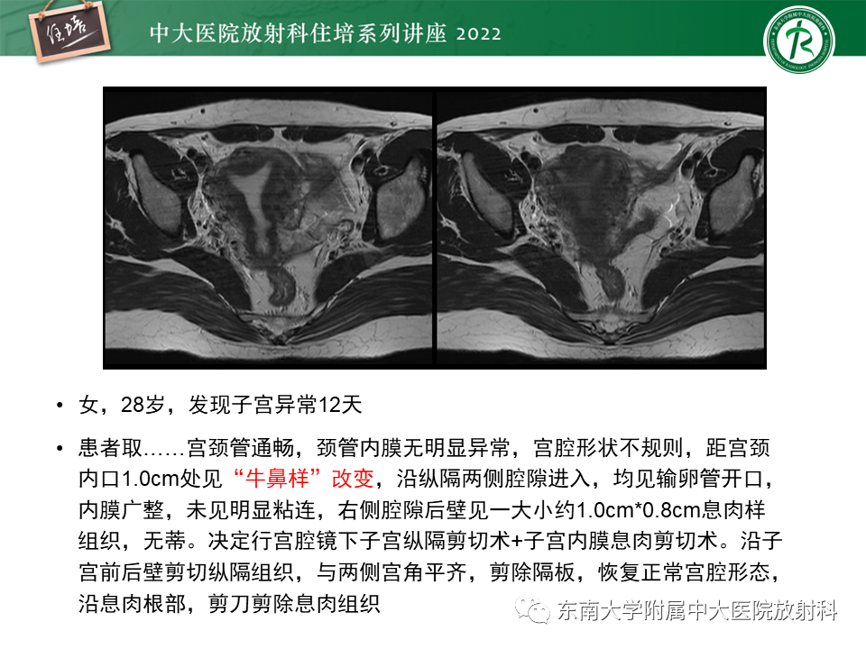 影像PPT - 【PPT】子宫畸形的分型与MR表现-24