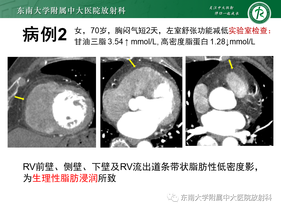 影像PPT - 【PPT】生理性和病理性心肌脂肪浸润-3