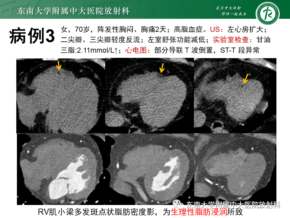影像PPT - 【PPT】生理性和病理性心肌脂肪浸润-4