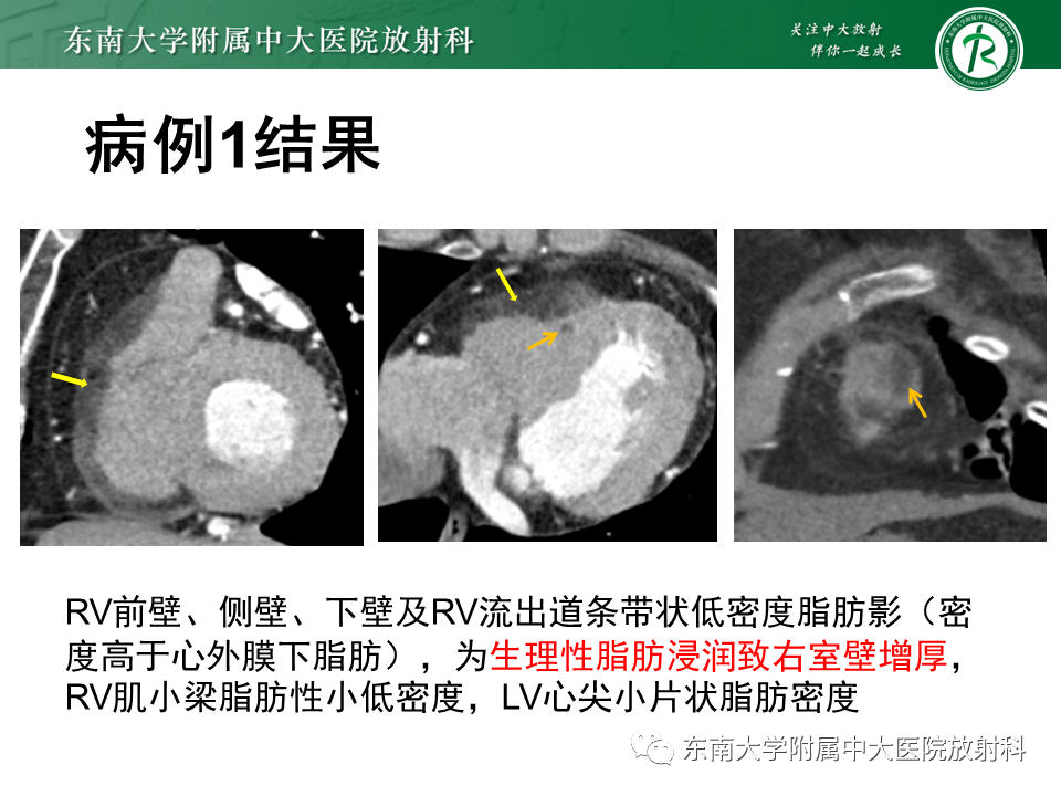 影像PPT - 【PPT】生理性和病理性心肌脂肪浸润-2