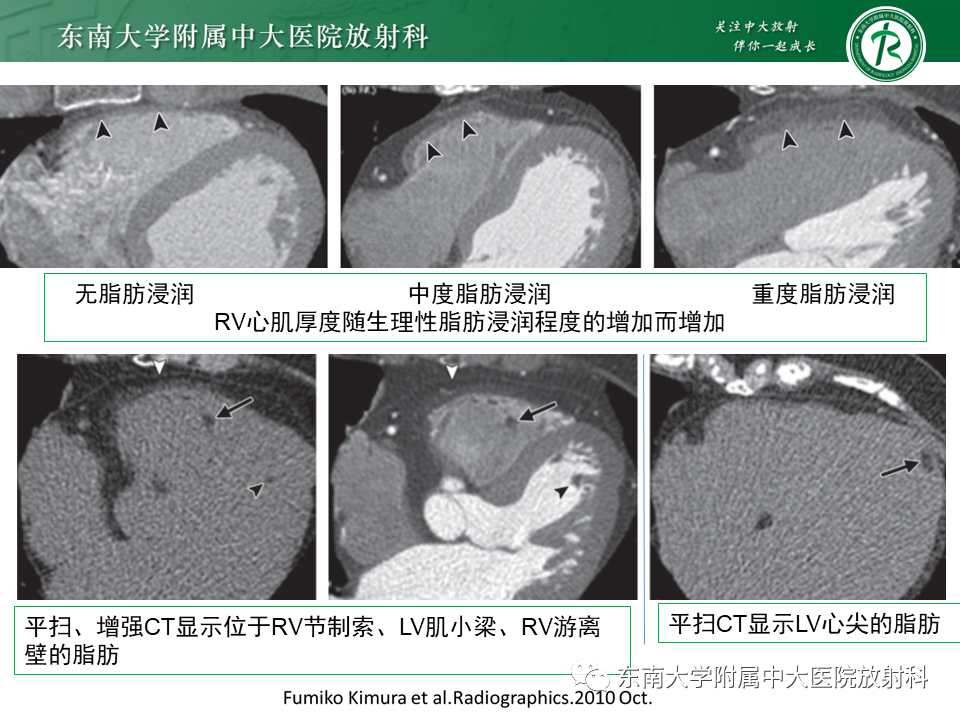 影像PPT - 【PPT】生理性和病理性心肌脂肪浸润-16