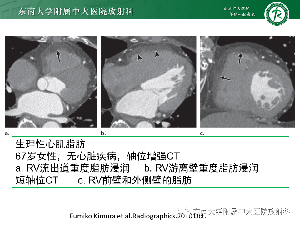 影像PPT - 【PPT】生理性和病理性心肌脂肪浸润-15