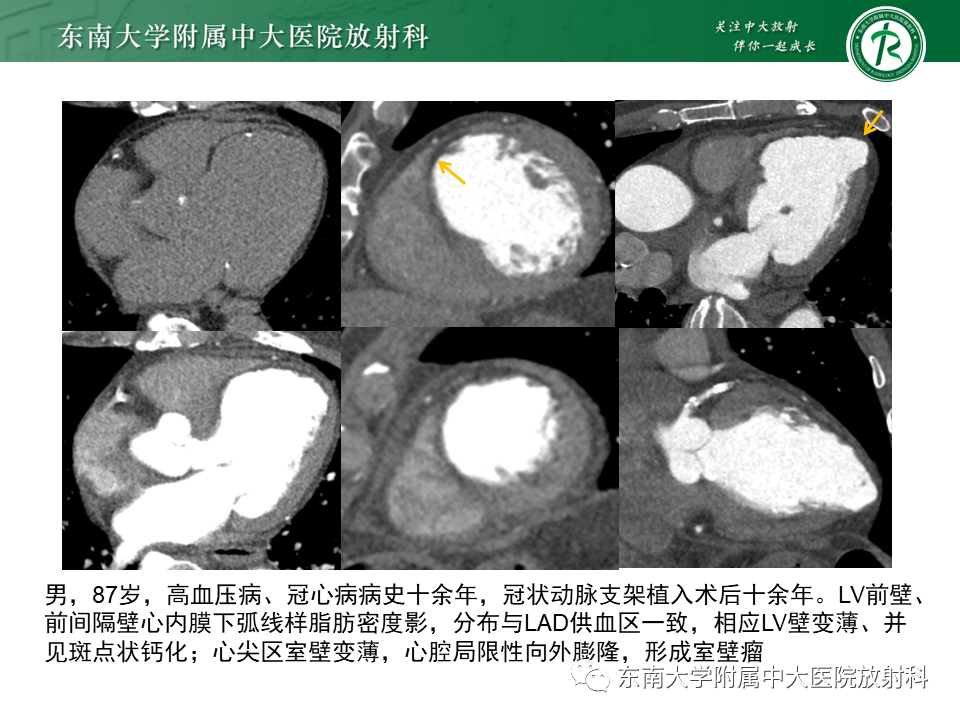 影像PPT - 【PPT】生理性和病理性心肌脂肪浸润-19