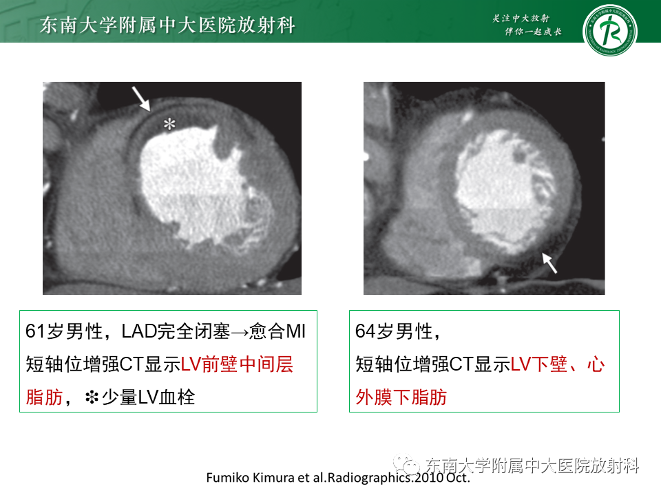影像PPT - 【PPT】生理性和病理性心肌脂肪浸润-21