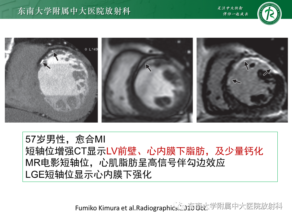 影像PPT - 【PPT】生理性和病理性心肌脂肪浸润-22