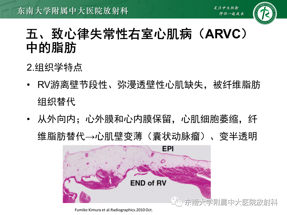 影像PPT - 【PPT】生理性和病理性心肌脂肪浸润-26