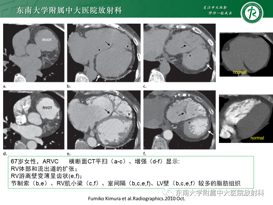 影像PPT - 【PPT】生理性和病理性心肌脂肪浸润-28