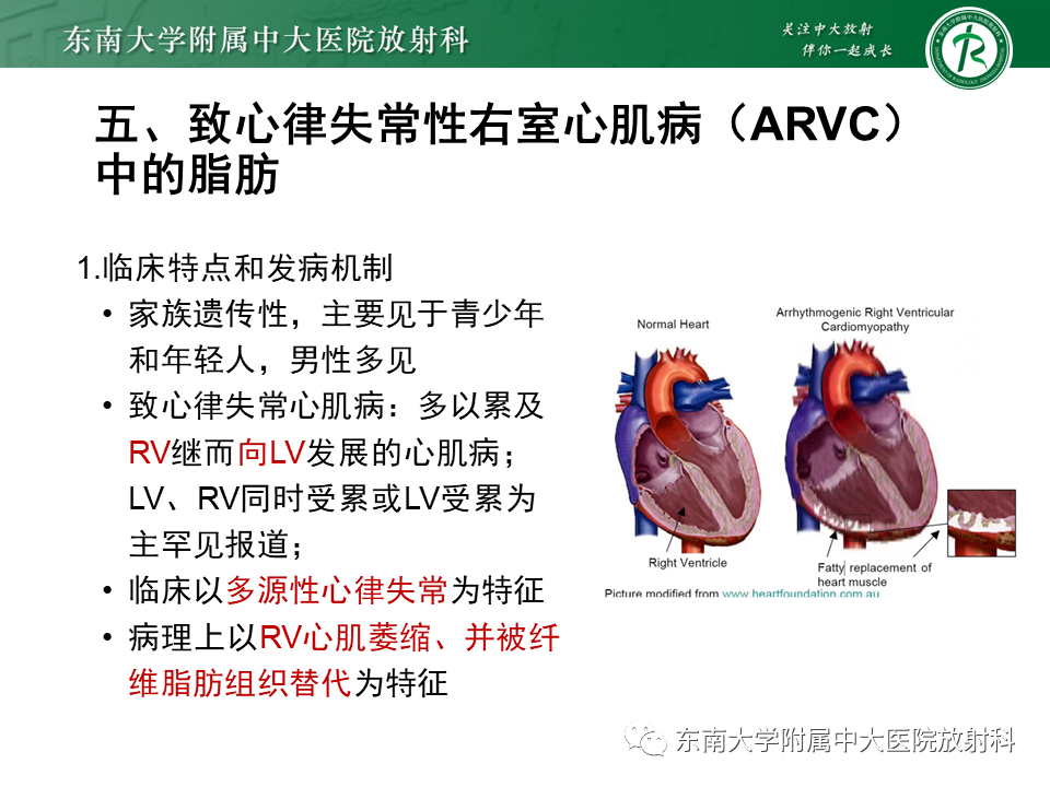影像PPT - 【PPT】生理性和病理性心肌脂肪浸润-25