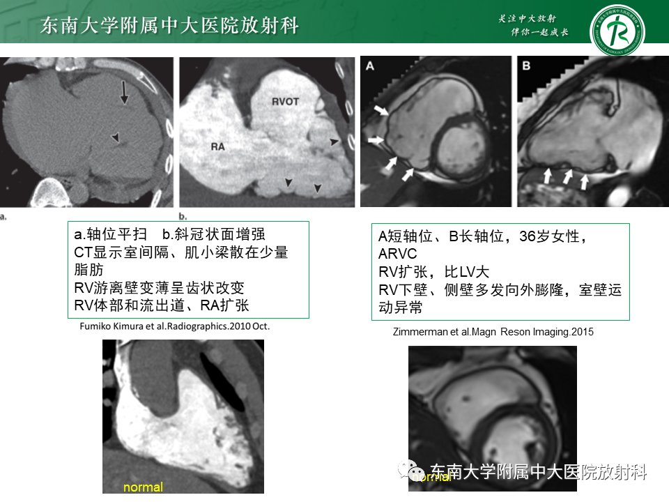 影像PPT - 【PPT】生理性和病理性心肌脂肪浸润-29