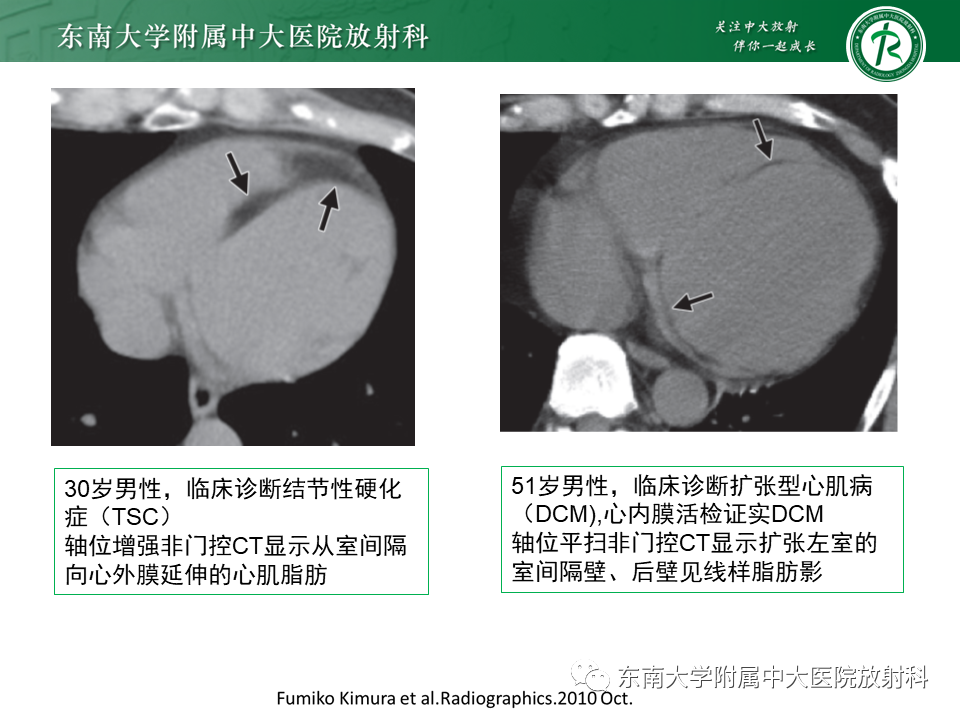 影像PPT - 【PPT】生理性和病理性心肌脂肪浸润-31