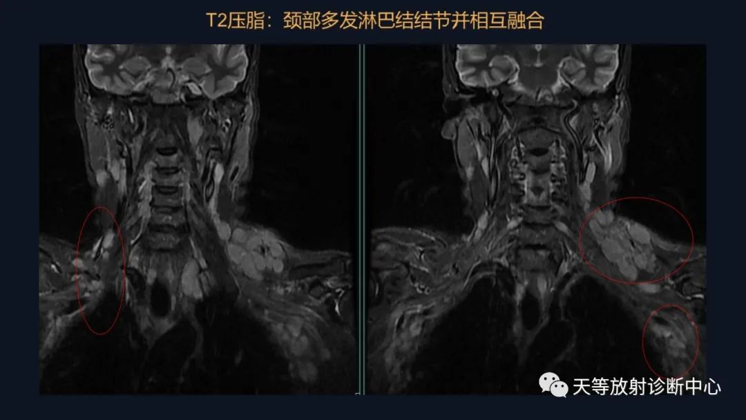 影像PPT - 【病例】脑内淋巴瘤1例MR影像分析-4 影像PPT - 【病例】脑内淋巴瘤1例MR影像分析-4