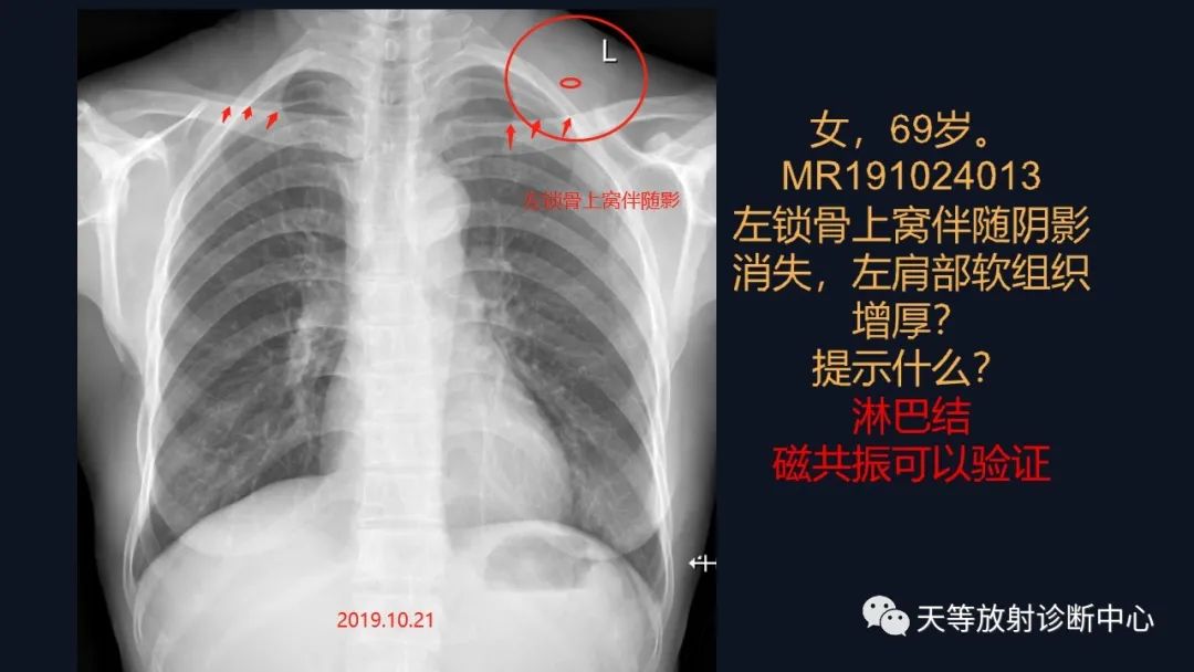 影像PPT - 【病例】脑内淋巴瘤1例MR影像分析-3 影像PPT - 【病例】脑内淋巴瘤1例MR影像分析-3