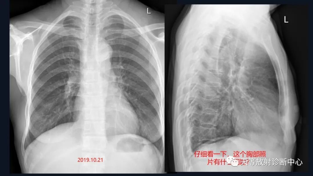 影像PPT - 【病例】脑内淋巴瘤1例MR影像分析-2 影像PPT - 【病例】脑内淋巴瘤1例MR影像分析-2