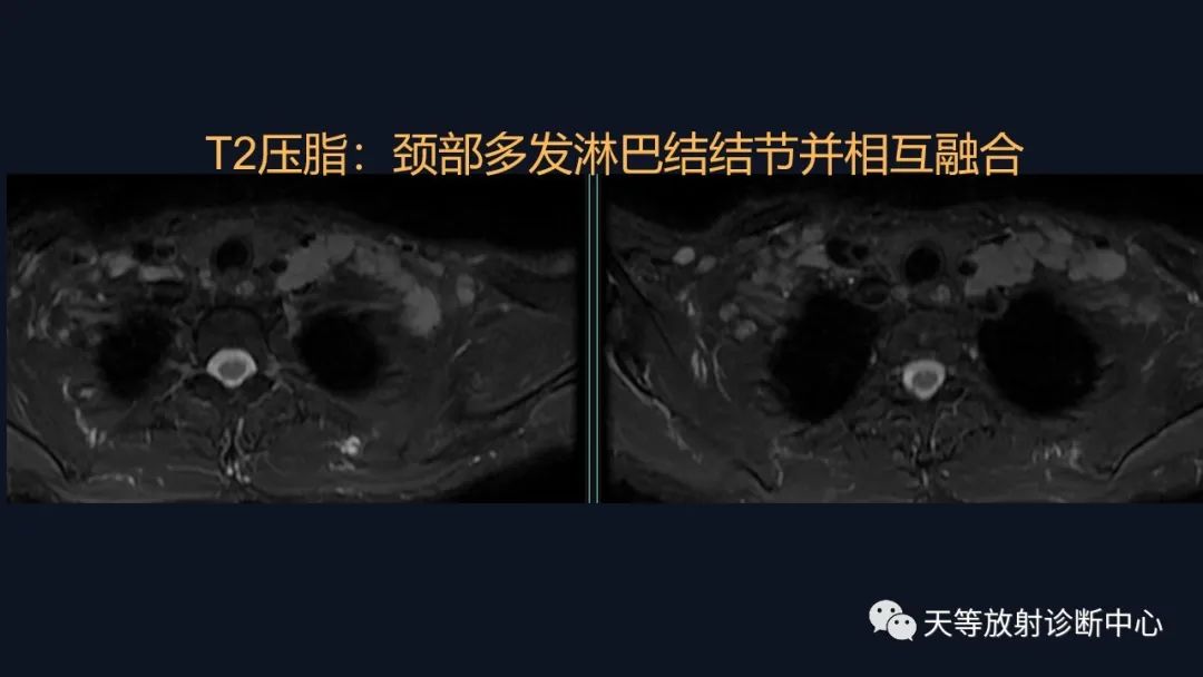 影像PPT - 【病例】脑内淋巴瘤1例MR影像分析-8 影像PPT - 【病例】脑内淋巴瘤1例MR影像分析-8