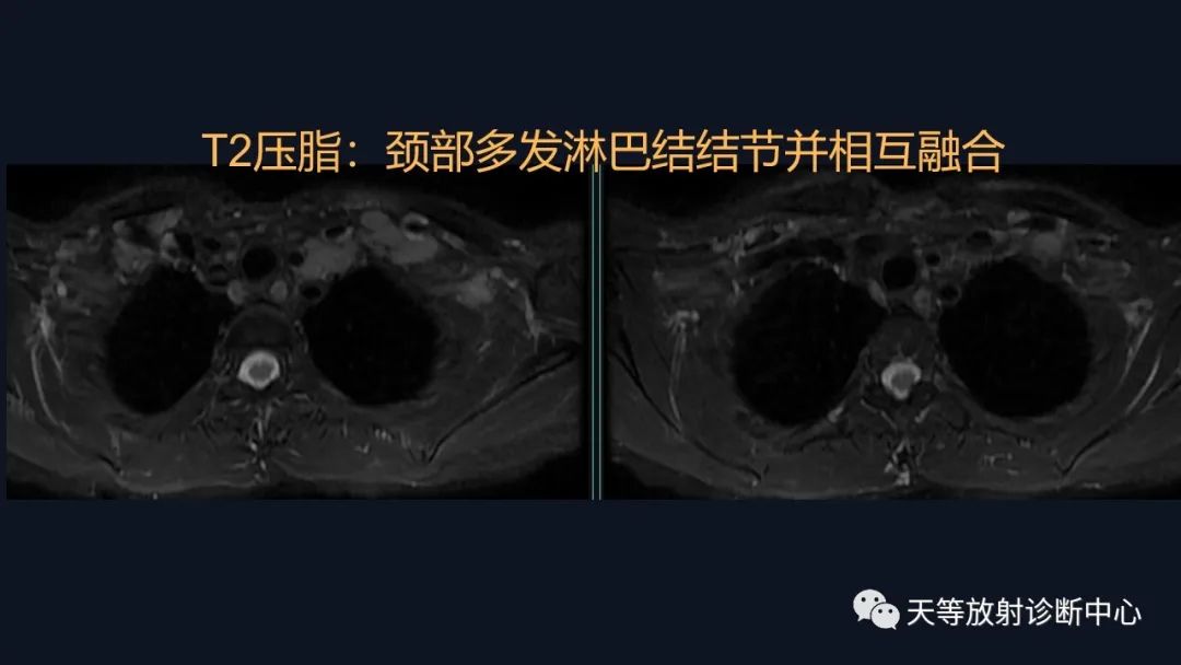 影像PPT - 【病例】脑内淋巴瘤1例MR影像分析-9 影像PPT - 【病例】脑内淋巴瘤1例MR影像分析-9