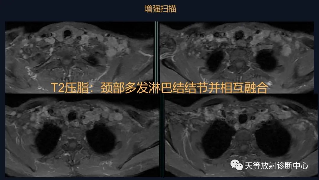 影像PPT - 【病例】脑内淋巴瘤1例MR影像分析-10 影像PPT - 【病例】脑内淋巴瘤1例MR影像分析-10