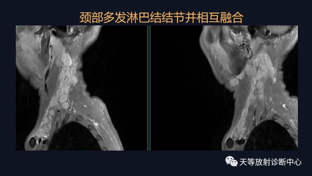 影像PPT - 【病例】脑内淋巴瘤1例MR影像分析-11 影像PPT - 【病例】脑内淋巴瘤1例MR影像分析-11