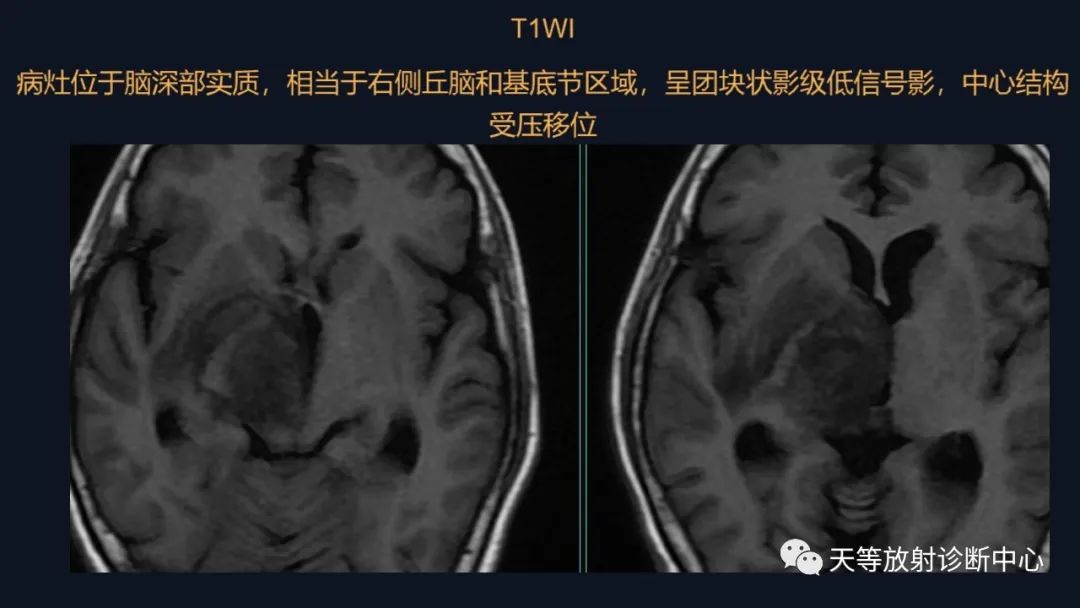 影像PPT - 【病例】脑内淋巴瘤1例MR影像分析-15 影像PPT - 【病例】脑内淋巴瘤1例MR影像分析-15