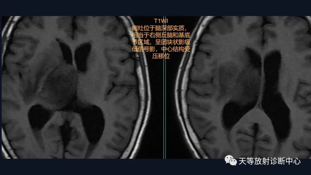 影像PPT - 【病例】脑内淋巴瘤1例MR影像分析-16 影像PPT - 【病例】脑内淋巴瘤1例MR影像分析-16