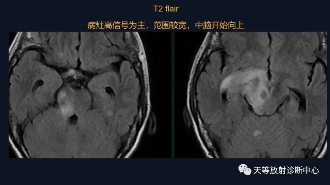 影像PPT - 【病例】脑内淋巴瘤1例MR影像分析-17 影像PPT - 【病例】脑内淋巴瘤1例MR影像分析-17