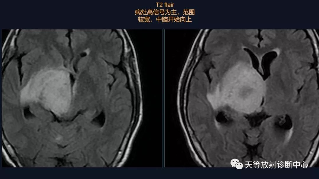 影像PPT - 【病例】脑内淋巴瘤1例MR影像分析-18 影像PPT - 【病例】脑内淋巴瘤1例MR影像分析-18