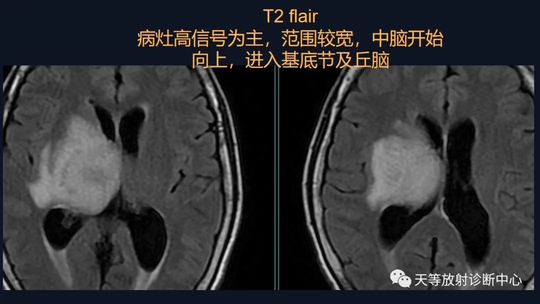 影像PPT - 【病例】脑内淋巴瘤1例MR影像分析-19 影像PPT - 【病例】脑内淋巴瘤1例MR影像分析-19