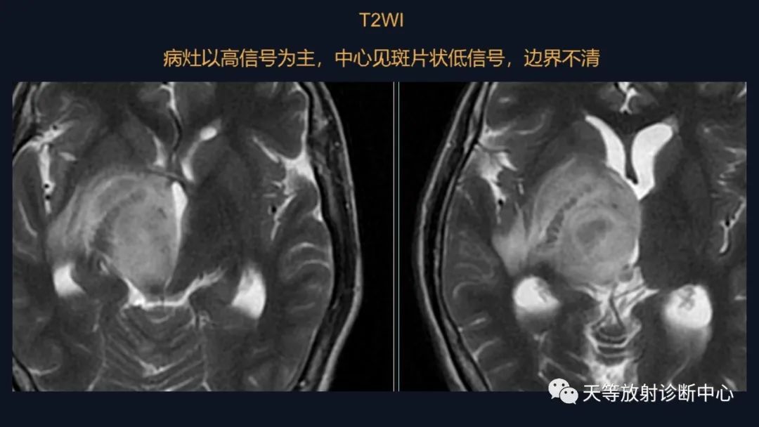 影像PPT - 【病例】脑内淋巴瘤1例MR影像分析-21 影像PPT - 【病例】脑内淋巴瘤1例MR影像分析-21