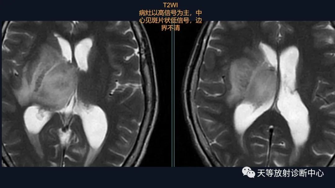 影像PPT - 【病例】脑内淋巴瘤1例MR影像分析-22 影像PPT - 【病例】脑内淋巴瘤1例MR影像分析-22