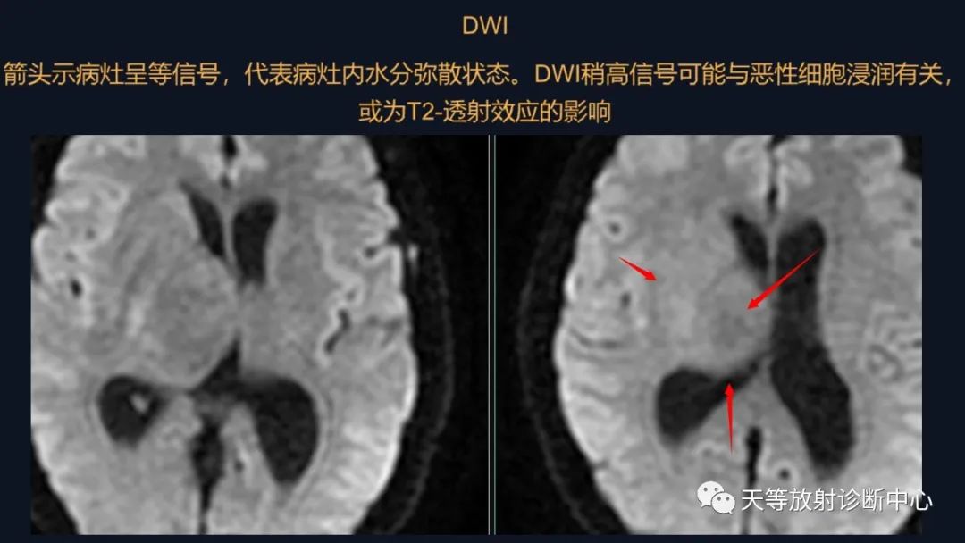 影像PPT - 【病例】脑内淋巴瘤1例MR影像分析-23 影像PPT - 【病例】脑内淋巴瘤1例MR影像分析-23