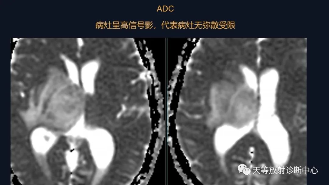 影像PPT - 【病例】脑内淋巴瘤1例MR影像分析-24 影像PPT - 【病例】脑内淋巴瘤1例MR影像分析-24