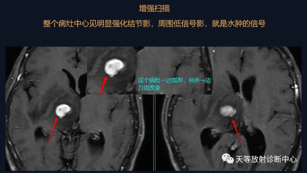 影像PPT - 【病例】脑内淋巴瘤1例MR影像分析-25 影像PPT - 【病例】脑内淋巴瘤1例MR影像分析-25