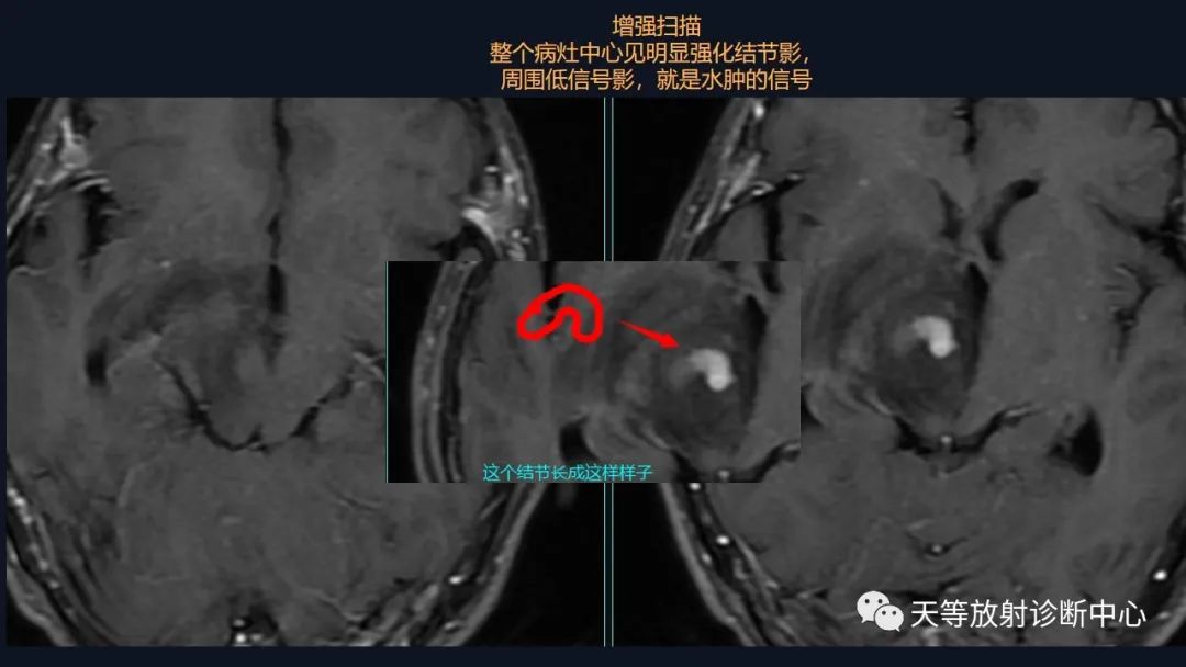 影像PPT - 【病例】脑内淋巴瘤1例MR影像分析-26 影像PPT - 【病例】脑内淋巴瘤1例MR影像分析-26
