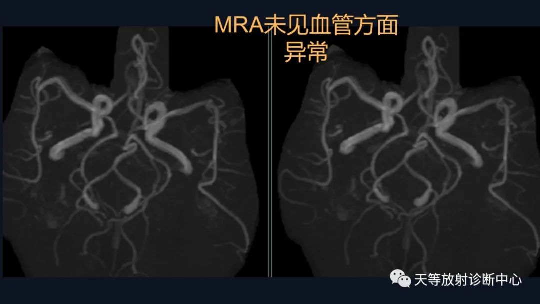 影像PPT - 【病例】脑内淋巴瘤1例MR影像分析-31 影像PPT - 【病例】脑内淋巴瘤1例MR影像分析-31